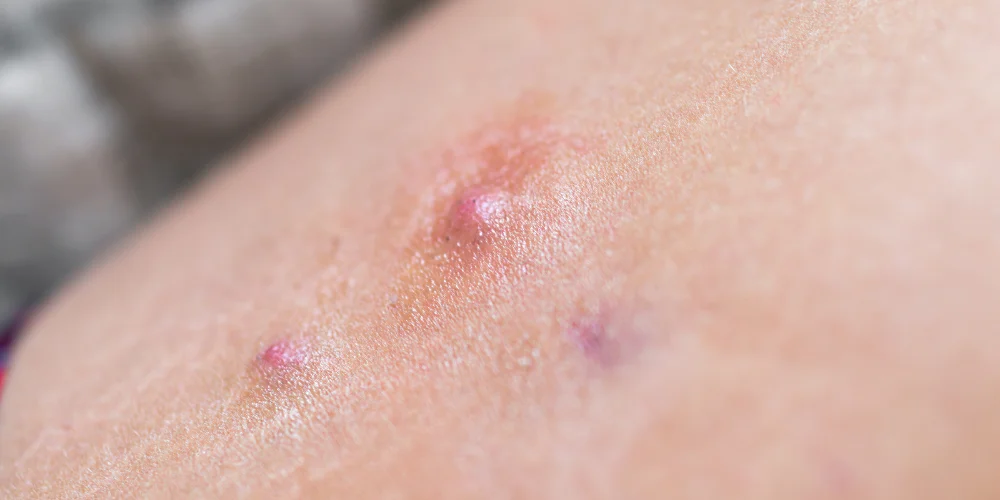 Köpek Memesi Hastalığı(Hidradenitis Süppürativa)